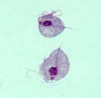 Human Trichomoniasis